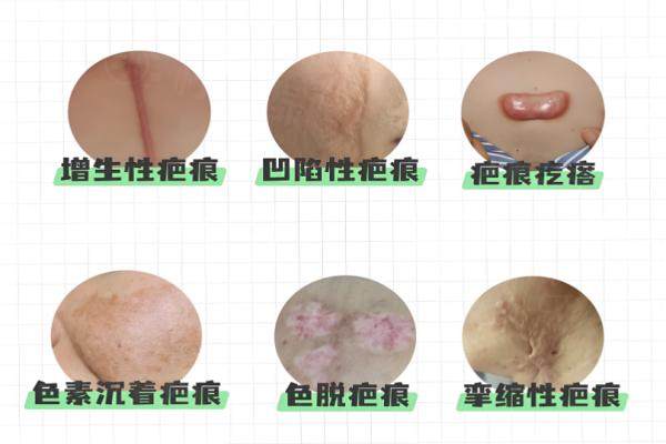 疤痕醫(yī)生楊東運(yùn)怎么預(yù)約？楊東運(yùn)疤痕修復(fù)案例分享