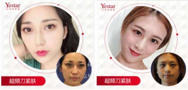 深圳藝星醫(yī)療美容醫(yī)院電話號碼是400，想去做面部抗衰的寶子們可別錯過這一優(yōu)質(zhì)醫(yī)美選擇！ 