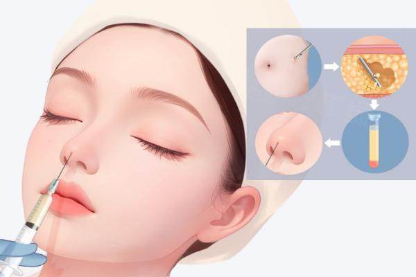 宮風(fēng)勇醫(yī)生做鼻子好嗎？初鼻案例詳解+鼻整形價格8k - 5w知多少