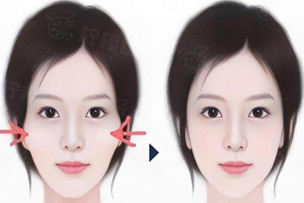 廣州做顴骨內(nèi)推哪里好？廣州藝星、廣州華美、廣州壹加壹這三家醫(yī)院技術(shù)超棒，值得考慮！ 