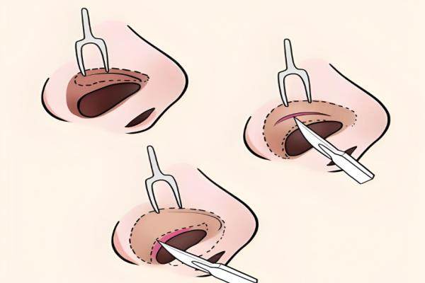 鄭州張鵬醫(yī)生做的鼻子后期穩(wěn)定性如何？案例見(jiàn)證：80+顧客反饋穩(wěn)定性