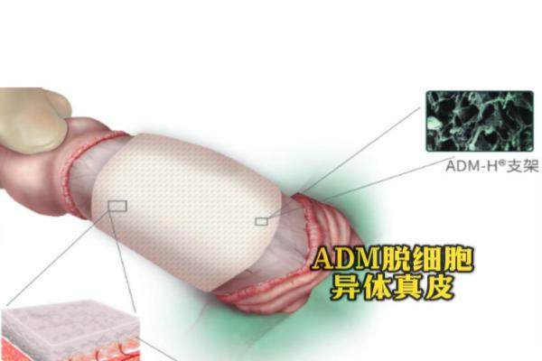 
生物補(bǔ)片是什么？男性陰莖增粗用生物補(bǔ)片增粗范圍揭秘?。?.8-3cm）