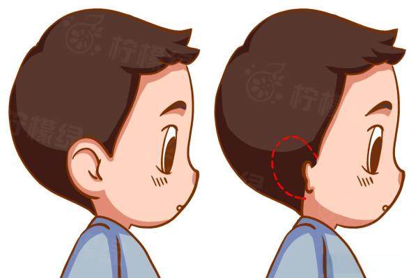 張?zhí)煊钚《中g(shù)一期做好多久做二期？上海全耳再造效果自然仿若天生