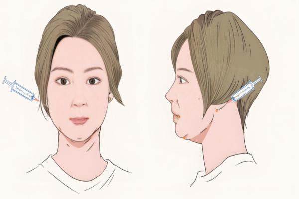 蔡跃波面部吸脂做的怎么样？南京华美专家分层精雕，微创恢复快