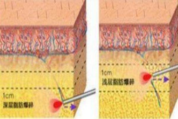 北京谷廷敏吸脂出名吗？低创伤技术恢复快价格透明，谷院长领衔定制方案效果自然优