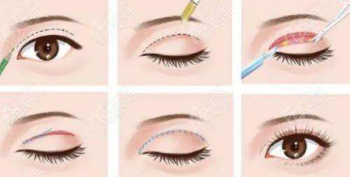 孝感黄清雨做手术怎么样？精细化定制效果自然，时光口碑佳收费透明亲民