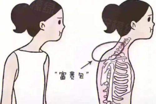 深圳富华唐新辉院长富贵包吸脂怎么样？分层吸脂技术扎实|费用透明|真实案例获求美者点赞