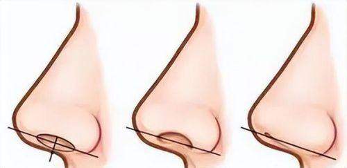 成都素美隆鼻怎么样？技术扎实|持四级资质价位透明，附初鼻/修复专属医生推荐