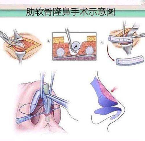 沈正宇医生做隆鼻怎么样？南京华美自然仿生肋软骨鼻综合修复技术好口碑佳