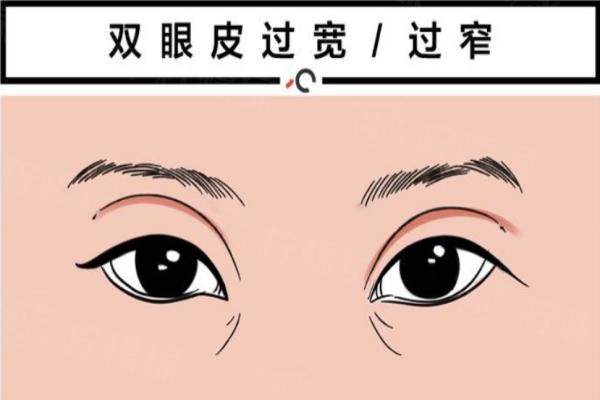 上海华美医疗美容医院双眼皮效果如何？采用先进微创技术塑造自然灵动双眸