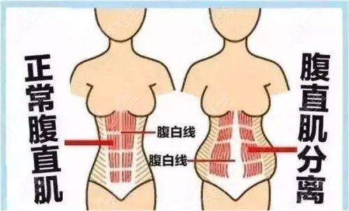 李献和医生的腹壁整形技术优势？依托显微外科与三甲平台实现精细修复