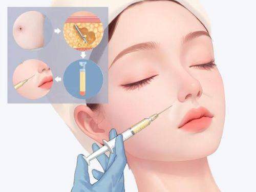 上海华美做脂肪填充怎么样？三级医院纳米技术存活高自然无痕