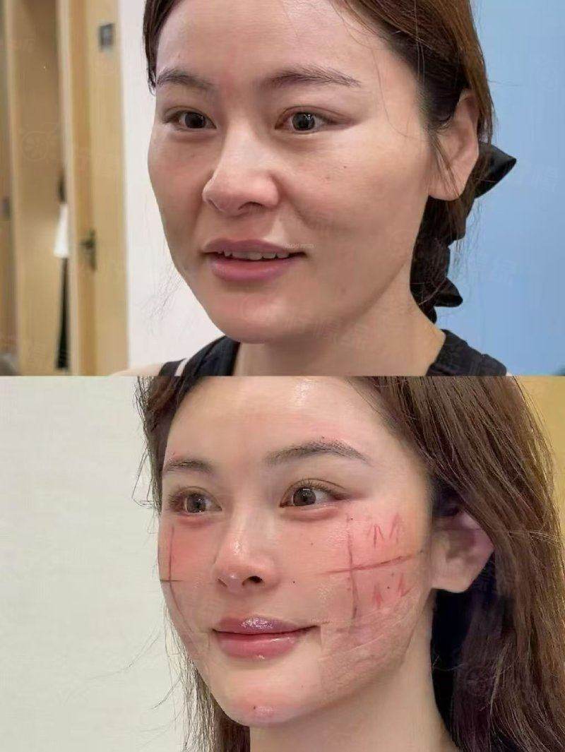 上海华美做眼综合怎么样？三级医院专家微创无痕打造妈生自然眼