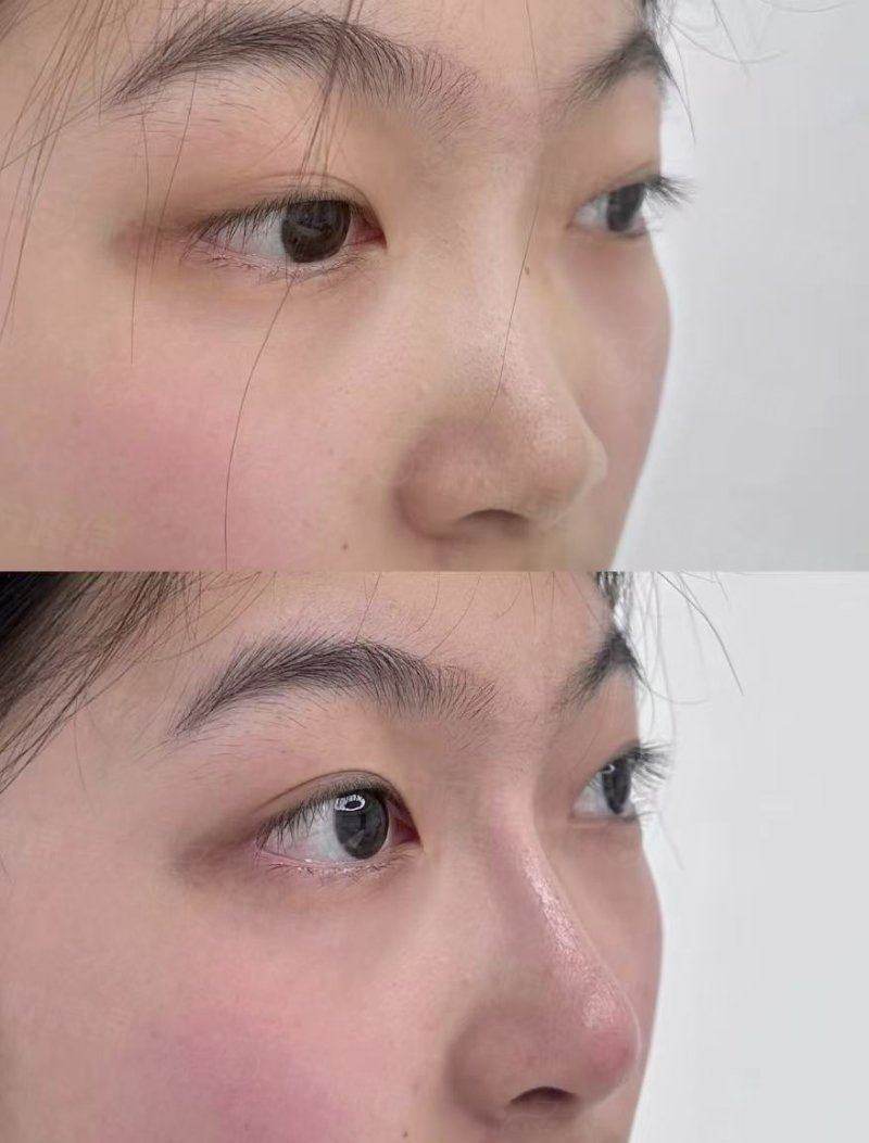 上海华美整形哪个医生最好专病专治副高专家主刀眼鼻修复自然