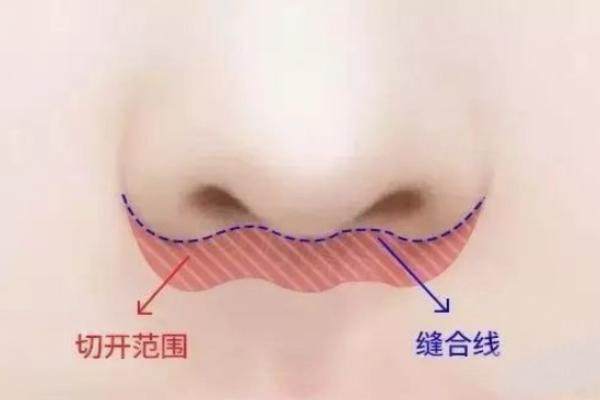 2026 人中缩短术疤痕明显吗》？长沙亚韩三级医院显微缝合让切口隐形自然