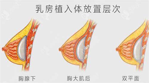 广州中山医科大学家庭医生整形美容医院隆胸修复怎么样？名校名医联手修复自然安全更放心