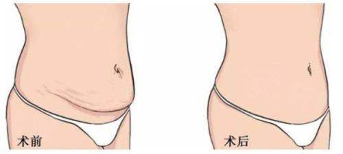 宁波鄞悦纤姿医美吸脂怎么样？正规院精细塑形自然流畅安全无忧