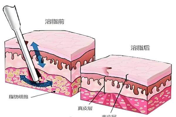 北京润美玉之光朱金城面部吸脂如何？技术精湛效果自然满意度高