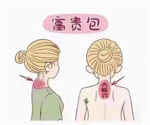 北京俊泰美好医疗美容做富贵包怎么样？微创去包体态矫正，正规医美重塑天鹅颈