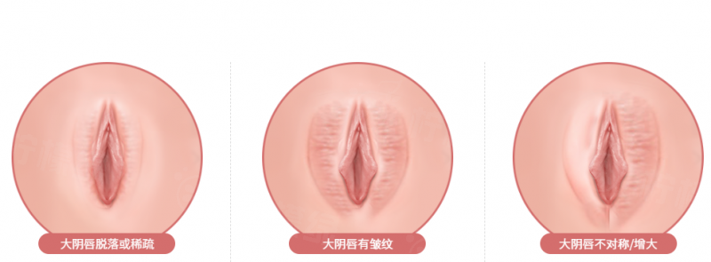 北京嘉禾整形医院私密整形怎么样？正规二级专科资深专家微创修复隐私安全