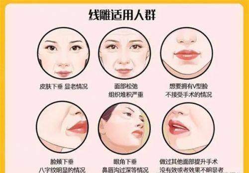 颧骨内推真实感受分享：医生技术精湛，术后效果自然，轻松拥有精致小脸！