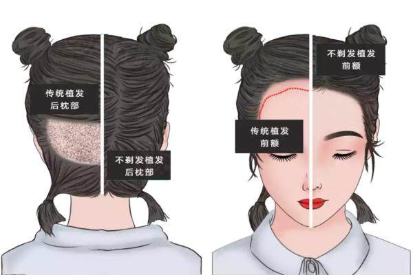 南宁华美植发医院正规吗好不好？专业植发技术先进效果自然备受好评