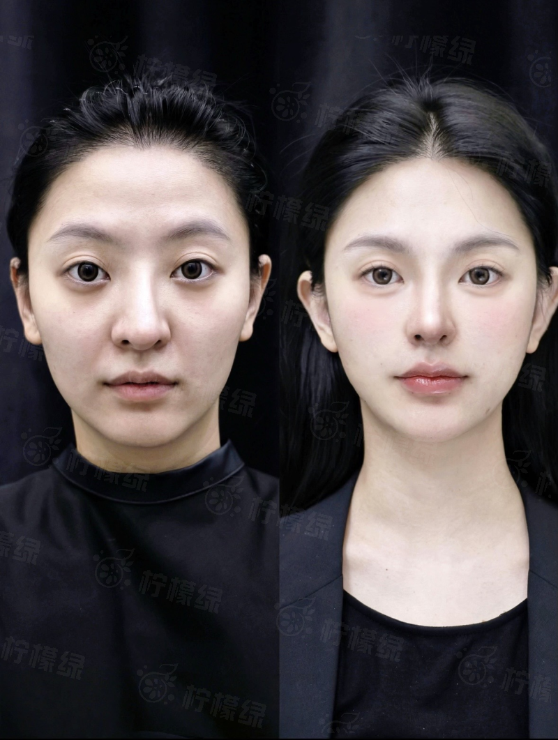 上海时光整形美容医院双眼皮割的怎么样？公立背景专家定制妈生款自然灵动