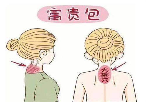 北京加减美医疗美容门诊部祛富贵包怎么样微创吸脂联合射频紧肤打造自然流畅颈背曲线