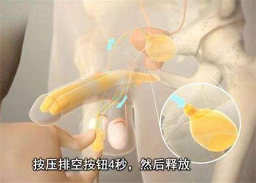 廖祥钧胸修复预约面诊深圳富华内窥镜双平面技术精准重塑自然胸型