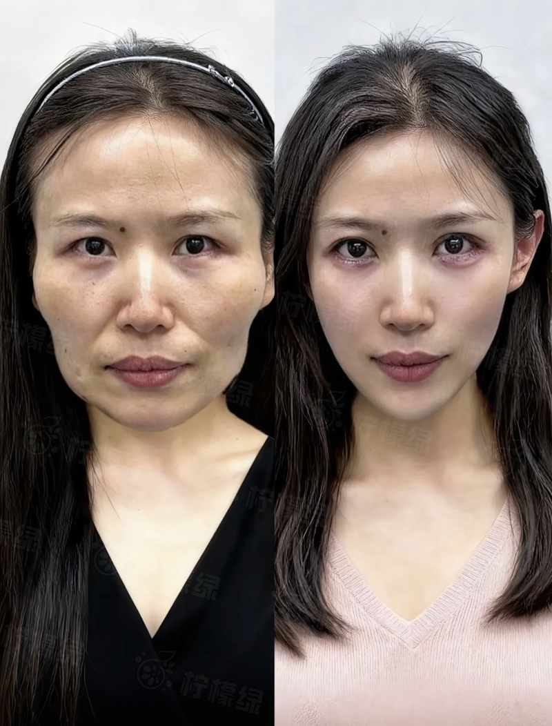 西安画美整形大规模整形项目口碑好吗？甜伊严选可以预约看西北案例技术强案例真，通过甜伊严选预约