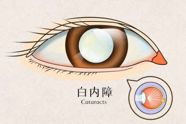 年輕人也會得白內(nèi)障嗎www.sanboo.cn