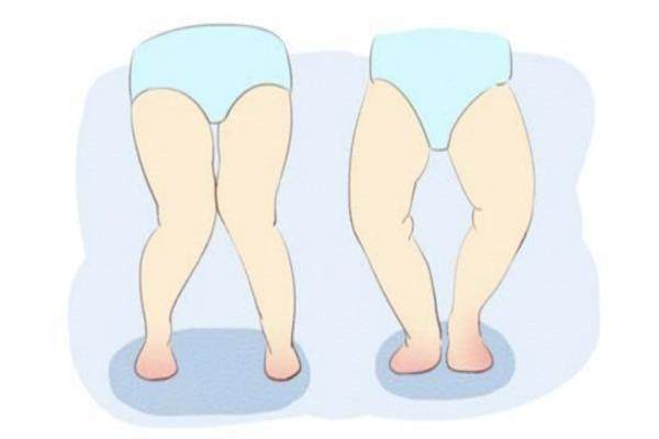 膝內(nèi)翻矯正.jpg