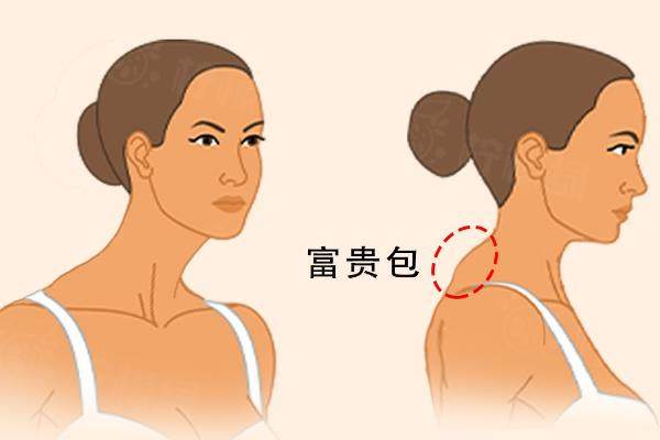 吸脂去富贵包www.okostu.com