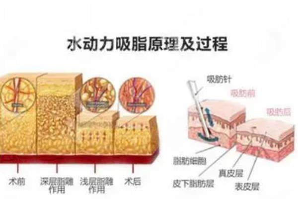 水動(dòng)力吸脂