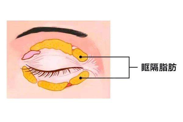 眶隔脂肪释放www.okostu.com