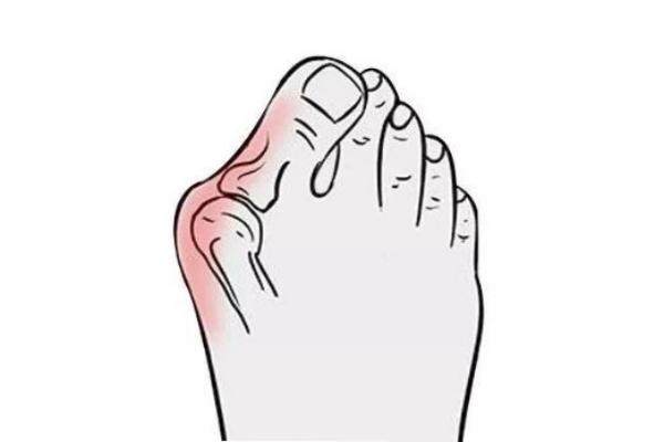 足部矯正www.sanboo.cn