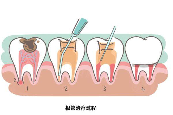 根管治療www.sanboo.cn
