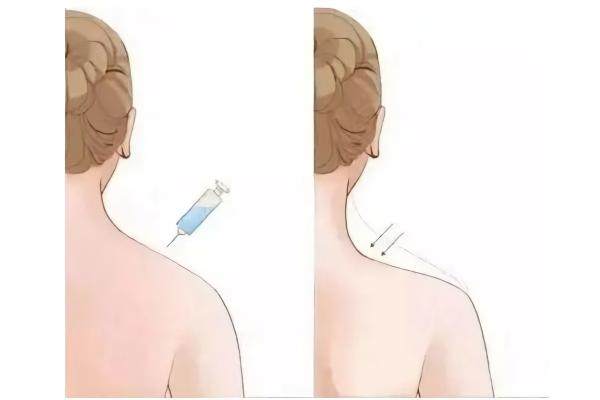 注射瘦肩肌www.sanboo.cn