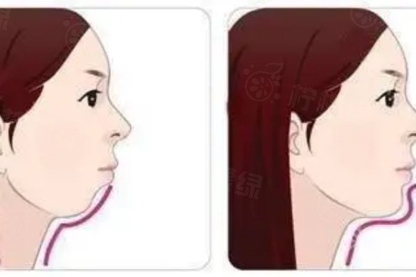 www.okostu.com自体脂肪垫下巴
