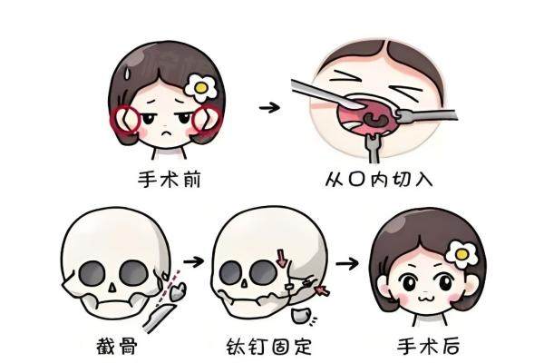 下巴截骨术牙齿麻木.jpg