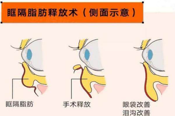眶隔脂肪释放2