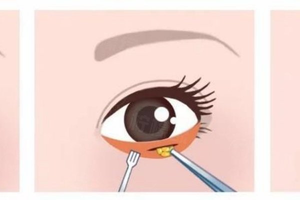 www.okostu.com上眼睑去脂