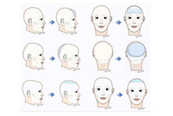 頭部整形http://www.sanboo.cn