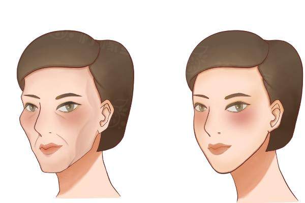 自體脂肪豐面頰www.sanboo.cn