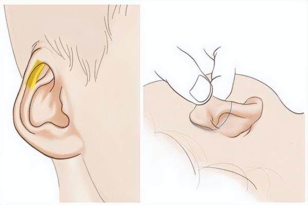 耳再造.jpg