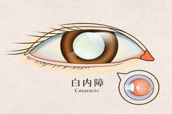 白內(nèi)障.jpg