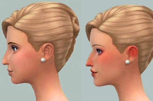 鷹鉤鼻矯正術(shù)會危險嗎