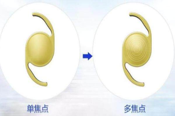 无极变焦人工晶体的价格表