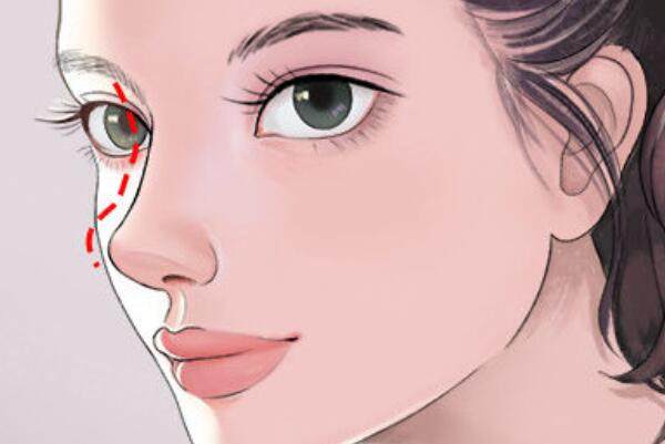 肋軟骨隆鼻是幾級手術(shù)