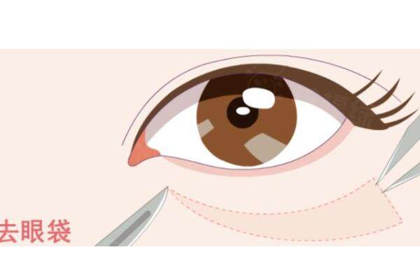 外切法去眼袋成效能維持多久